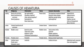 CAUSES OF HEMATURIA
6
 