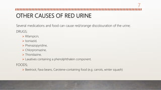 OTHER CAUSES OF RED URINE
Several medications and food can cause red/orange discolouration of the urine;
DRUGS;
 Rifampicin,
 Isoniazid,
 Phenazopyridine,
 Chlorpromazine,
 Thioridazine,
 Laxatives containing a phenolphthalein component.
FOODS;
 Beetroot, Fava beans, Carotene-containing food (e.g. carrots, winter squash)
7
 