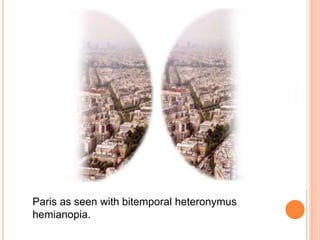 Bitemporal Heteronymous Hemianopia | PPTX