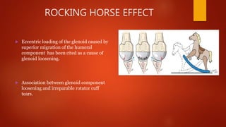 ROCKING HORSE EFFECT
 Eccentric loading of the glenoid caused by
superior migration of the humeral
component has been cited as a cause of
glenoid loosening.
 Association between glenoid component
loosening and irreparable rotator cuff
tears.
 