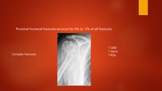Proximal humeral fractures account for 4% to 5% of all fractures
? ORIF
? Hemi
? RSAComplex fractures
 