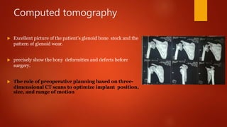 Computed tomography
 Excellent picture of the patient’s glenoid bone stock and the
pattern of glenoid wear.
 precisely show the bony deformities and defects before
surgery.
 The role of preoperative planning based on three-
dimensional CT scans to optimize implant position,
size, and range of motion
 