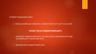PATIENT MANAGED WITH
 MODULAR BIPOLAR CEMENTED HEMIARTHROPLASTY LEFT SHOULDER
OTHER TYPE OF HEMIARTHROPLASTY :
1. MODIFIED HEMIARTHROPLASTY: INTERPOSITION ARTHROPLASTY AND
GLENOIDPLASTY (REAM AND RUN)
2. RESURFACING HEMIARTHROPLASTY
 