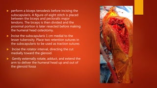  perform a biceps tenodesis before incising the
subscapularis. A ﬁgure-of-eight stitch is placed
between the biceps and pectoralis major
tendons. The biceps is then divided and the
proximal portion is later resected before making
the humeral head osteotomy.
 Incise the subscapularis 1 cm medial to the
lesser tuberosity. Place two retention sutures in
the subscapularis to be used as traction sutures
 Incise the rotator interval, directing the cut
medially toward the glenoid.
 Gently externally rotate, adduct, and extend the
arm to deliver the humeral head up and out of
the glenoid fossa
 