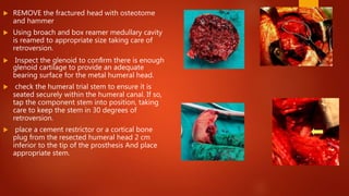  REMOVE the fractured head with osteotome
and hammer
 Using broach and box reamer medullary cavity
is reamed to appropriate size taking care of
retroversion.
 Inspect the glenoid to conﬁrm there is enough
glenoid cartilage to provide an adequate
bearing surface for the metal humeral head.
 check the humeral trial stem to ensure it is
seated securely within the humeral canal. If so,
tap the component stem into position, taking
care to keep the stem in 30 degrees of
retroversion.
 place a cement restrictor or a cortical bone
plug from the resected humeral head 2 cm
inferior to the tip of the prosthesis And place
appropriate stem.
 