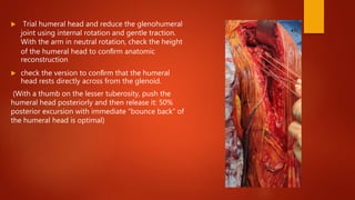  Trial humeral head and reduce the glenohumeral
joint using internal rotation and gentle traction.
With the arm in neutral rotation, check the height
of the humeral head to conﬁrm anatomic
reconstruction
 check the version to conﬁrm that the humeral
head rests directly across from the glenoid.
(With a thumb on the lesser tuberosity, push the
humeral head posteriorly and then release it: 50%
posterior excursion with immediate “bounce back” of
the humeral head is optimal)
 