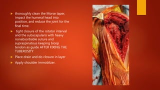  thoroughly clean the Morse taper,
impact the humeral head into
position, and reduce the joint for the
ﬁnal time.
 tight closure of the rotator interval
and the subscapularis with heavy
nonabsorbable suture and
supraspinatous keeping bicep
tendon as guide AFTER FIXING THE
TUBEROSITY
 Place drain and do closure in layer
 Apply shoulder immoblizer.
 