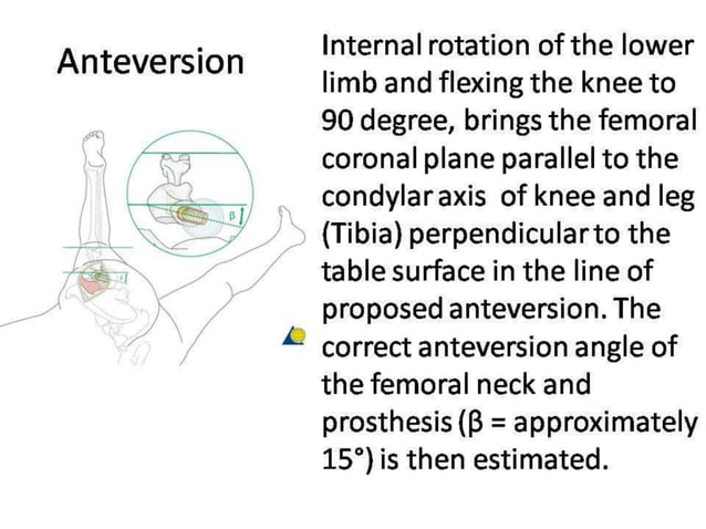 Hemiarthroplasty in Unstable Trochanteric Fractures.pptx