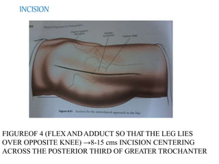 hemiarthroplastyunipolarandbipolarindicationsapproachandprocedure ...