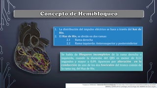1. La distribución del impulso eléctrico se hace a través del haz de
His.
2. El Haz de His, se divide en dos ramas:
2.1 Rama derecha
2.2 Rama izquierda: Anterosuperior y posteroinferior
Se habla de Bloqueos incompletos de la rama derecha o
izquierda, cuando la duración del QRS es menor de 0,12
segundos y mayor a 0,09. Aparecen por alteración en la
conducción de uno de los dos fascículos del tronco común de
la rama izq. del Haz de His.
Tomado de: GONZALEZ J. Tutorial de Electrocardiograma. Sin fecha. http://www.urgenciauc.com/profesion/pdf/ecg_tutorial.pdf
JIMENEZ y GAUDÓ (2013). Cardiología y Neumonología. Edit: MARBÁN. Barcelona: España
 