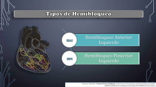 Hemibloqueo Anterior
Izquierdo
Hemibloqueo Posterior
Izquierdo
Tomado de: GONZALEZ J. Tutorial de Electrocardiograma. Sin fecha. http://www.urgenciauc.com/profesion/pdf/ecg_tutorial.pdf
JIMENEZ y GAUDÓ (2013). Cardiología y Neumonología. Edit: MARBÁN. Barcelona: España
 