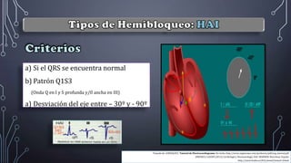 a) Si el QRS se encuentra normal
b) Patrón Q1S3
(Onda Q en I y S profunda y/0 ancha en III)
a) Desviación del eje entre – 30º y - 90º
Tomado de: GONZALEZ J. Tutorial de Electrocardiograma. Sin fecha. http://www.urgenciauc.com/profesion/pdf/ecg_tutorial.pdf
JIMENEZ y GAUDÓ (2013). Cardiología y Neumonología. Edit: MARBÁN. Barcelona: España
http://www.lrubio.es/ECG/tema3/tema3-4.html
 