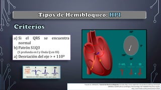 a) Si el QRS se encuentra
normal
b) Patrón S1Q3
(S profunda en I y Onda Q en III)
a) Desviación del eje > + 110º
Tomado de: GONZALEZ J. Tutorial de Electrocardiograma. Sin fecha. http://www.urgenciauc.com/profesion/pdf/ecg_tutorial.pdf
JIMENEZ y GAUDÓ (2013). Cardiología y Neumonología. Edit: MARBÁN. Barcelona: España
http://www.lrubio.es/ECG/tema3/tema3-4.html
 