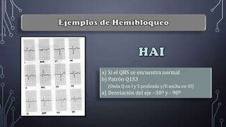 a) Si el QRS se encuentra normal
b) Patrón Q1S3
(Onda Q en I y S profunda y/0 ancha en III)
a) Desviación del eje –30º y - 90º
 