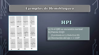 a) Si el QRS se encuentra normal
b) Patrón S1Q3
(S profunda en I y Onda Q en III)
a) Desviación del eje > + 110º
 
