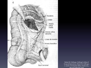 Robert M. Zollinger,Zollinger'sAtlas of
SurgicalOperations, Robert M. Zollinger,
Jr. and E. Christopher Elliso, 8 edicicion,
 