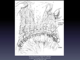 Robert M. Zollinger,Zollinger'sAtlas of
SurgicalOperations, Robert M. Zollinger,
Jr. and E. Christopher Elliso, 8 edicicion,
 