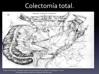 Colectomía total.
Robert M. Zollinger,Zollinger'sAtlas of SurgicalOperations, Robert M. Zollinger, Jr. and E.
Christopher Elliso, 8 edicicion, Mcgraw-Hill USA 2008
 