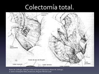Colectomía total.
Robert M. Zollinger,Zollinger's Atlas of SurgicalOperations, Robert M. Zollinger,
Jr. and E. Christopher Elliso, 8 edicicion, Mcgraw-HillUSA 2008
 