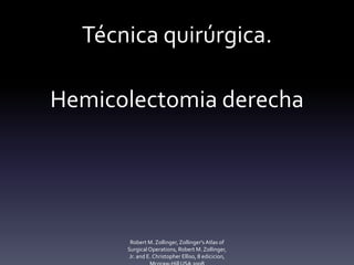 Técnica quirúrgica.
Hemicolectomia derecha
Robert M. Zollinger,Zollinger'sAtlas of
SurgicalOperations, Robert M. Zollinger,
Jr. and E. Christopher Elliso, 8 edicicion,
 