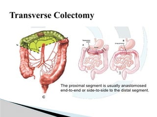 Hemicolectomy types with anatomy seminar | PPTX