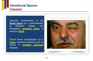 Hemifacial Spasm
Causes:
33
• Vascular compression of the
facial nerve by a dolichoectatic
(a distorted, dilated, and
elongated) vertebral artery or
tortuous AICA.
• Facial nerve compression by a
mass, brainstem lesions such as
stroke or multiple sclerosis
plaques.
 