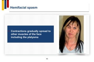 Hemifacial spasm
43
• Contractions gradually spread to
other muscles of the face
including the platysma
 