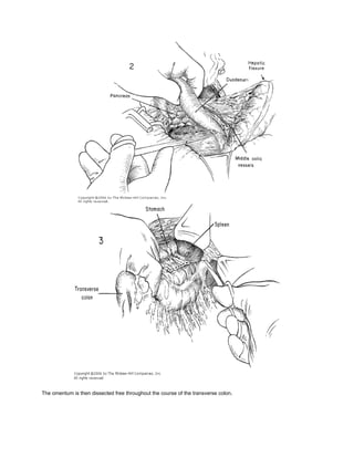 The omentum is then dissected free throughout the course of the transverse colon.
 