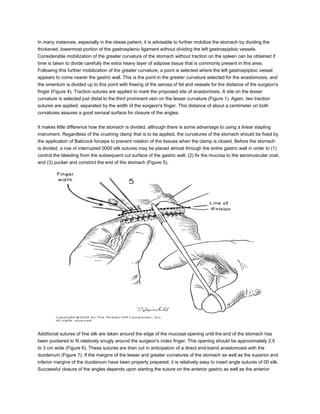 In many instances, especially in the obese patient, it is advisable to further mobilize the stomach by dividing the
thickened, lowermost portion of the gastrosplenic ligament without dividing the left gastroepiploic vessels.
Considerable mobilization of the greater curvature of the stomach without traction on the spleen can be obtained if
time is taken to divide carefully the extra heavy layer of adipose tissue that is commonly present in this area.
Following this further mobilization of the greater curvature, a point is selected where the left gastroepiploic vessel
appears to come nearer the gastric wall. This is the point in the greater curvature selected for the anastomosis, and
the omentum is divided up to this point with freeing of the serosa of fat and vessels for the distance of the surgeon's
finger (Figure 4). Traction sutures are applied to mark the proposed site of anastomosis. A site on the lesser
curvature is selected just distal to the third prominent vein on the lesser curvature (Figure 1). Again, two traction
sutures are applied, separated by the width of the surgeon's finger. This distance of about a centimeter on both
curvatures assures a good serosal surface for closure of the angles.


It makes little difference how the stomach is divided, although there is some advantage to using a linear stapling
instrument. Regardless of the crushing clamp that is to be applied, the curvatures of the stomach should be fixed by
the application of Babcock forceps to prevent rotation of the tissues when the clamp is closed. Before the stomach
is divided, a row of interrupted 0000 silk sutures may be placed almost through the entire gastric wall in order to (1)
control the bleeding from the subsequent cut surface of the gastric wall, (2) fix the mucosa to the seromuscular coat,
and (3) pucker and constrict the end of the stomach (Figure 5).




Additional sutures of fine silk are taken around the edge of the mucosal opening until the end of the stomach has
been puckered to fit relatively snugly around the surgeon's index finger. This opening should be approximately 2.5
to 3 cm wide (Figure 6). These sutures are then cut in anticipation of a direct end-toend anastomosis with the
duodenum (Figure 7). If the margins of the lesser and greater curvatures of the stomach as well as the superior and
inferior margins of the duodenum have been properly prepared, it is relatively easy to insert angle sutures of 00 silk.
Successful closure of the angles depends upon starting the suture on the anterior gastric as well as the anterior
 