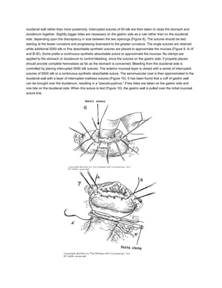 duodenal wall rather than more posteriorly. Interrupted sutures of 00 silk are then taken to close the stomach and
duodenum together. Slightly bigger bites are necessary on the gastric side as a rule rather than on the duodenal
side, depending upon the discrepancy in size between the two openings (Figure 8). The sutures should be tied,
starting at the lesser curvature and progressing downward to the greater curvature. The angle sutures are retained
while additional 0000 silk or fine absorbable synthetic sutures are placed to approximate the mucosa (Figure 9, A–A'
and B–B'). Some prefer a continuous synthetic absorbable suture to approximate the mucosa. No clamps are
applied to the stomach or duodenum to control bleeding, since the sutures on the gastric side, if properly placed,
should provide complete hemostasis as far as the stomach is concerned. Bleeding from the duodenal side is
controlled by placing interrupted 0000 silk sutures. The anterior mucosal layer is closed with a series of interrupted
sutures of 0000 silk or a continuous synthetic absorbable suture. The seromuscular coat is then approximated to the
duodenal wall with a layer of interrupted mattress sutures (Figure 10). It has been found that a cuff of gastric wall
can be brought over the duodenum, resulting in a "pseudo-pylorus," if two bites are taken on the gastric side and
one bite on the duodenal side. When this suture is tied (Figure 10), the gastric wall is pulled over the initial mucosal
suture line.
 