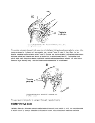 The vascular pedicles on the gastric side are anchored to the ligated right gastric pedicle along the top surface of the
duodenum as well as the ligated right gastroepiploic artery pedicle (Figure 10, A and B). A and B are then tied
together to seal the greater curvature angle (Figure 11). A similar type of approximation is effected along the superior
surface in order to seal the angle and remove all tension from the anastomosis (Figure 11). Cushing silver clips
placed at the site of anastomosis will aid in identifying this area when future x-rays are obtained. The stoma should
admit one finger relatively easily. There should be no tension whatsoever on the suture line.




The upper quadrant is inspected for oozing and thoroughly irrigated with saline.

POSTOPERATIVE CARE

Two liters of Ringer's lactate are given and the blood volume restored during the first 24 hours. The nasogastric tube
is allowed to drain by gravity or is attached to low-pressure suction. Frequent irrigations of the tube with small
 