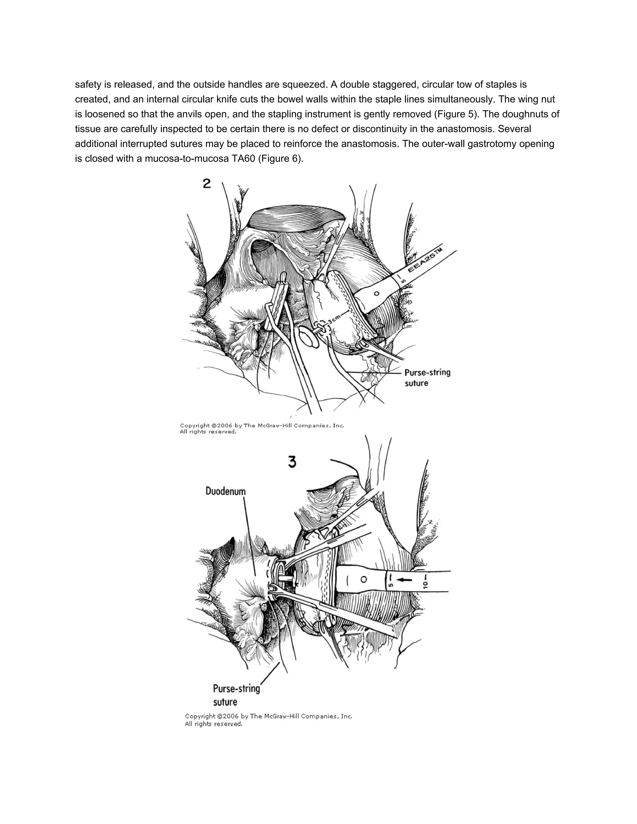 Hemigastrectomy, billroth I stapled | DOC