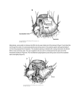 Alternatively, some prefer to introduce the EEA into the open distal end of the stomach (Figure 7) and direct the
rod through the center of a previously placed purse-string suture in the posterior gastric wall approximately 3
cm from the proposed line of resection. The duodenal opening is checked with a sizing instrument; the 28-mm
EEA is most commonly used. The cap is applied to the rod, and it is introduced into the open end of the
transected duodenum (Figure 8). The monofilament polypropylene purse-string suture around the duodenal
wall is tied tightly (Figure 9).
 