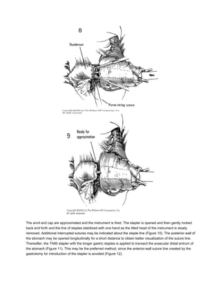The anvil and cap are approximated and the instrument is fired. The stapler is opened and then gently rocked
back and forth and the line of staples stabilized with one hand as the tilted head of the instrument is slowly
removed. Additional interrupted sutures may be indicated about the staple line (Figure 10). The posterior wall of
the stomach may be opened longitudinally for a short distance to obtain better visualization of the suture line.
Thereafter, the TA90 stapler with the longer gastric staples is applied to transect the avascular distal antrum of
the stomach (Figure 11). This may be the preferred method, since the anterior-wall suture line created by the
gastrotomy for introduction of the stapler is avoided (Figure 12).
 