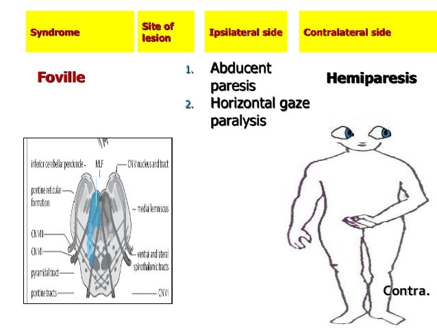 Hemiplegia Hemiplegia