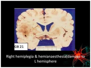 Right hemiplegia & hemianaesthesia(damage to 
L hemisphere 
 