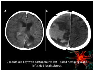9 month old boy with postoperative left – sided hemiplegia and 
left sided local seizures 
 