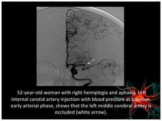 52-year-old woman with right hemiplegia and aphasia. Left 
internal carotid artery injection with blood pressure at baseline, 
early arterial phase, shows that the left middle cerebral artery is 
occluded (white arrow). 
 