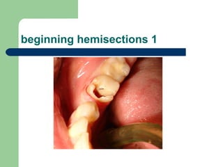 Tooth Hemisection Hemisections teeth 46 | PPT