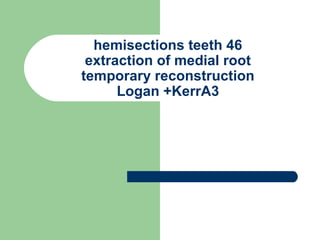 hemisections teeth 46
extraction of medial root
temporary reconstruction
Logan +KerrA3
 