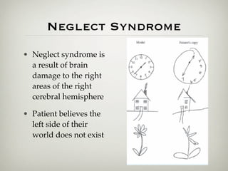 Neglect Syndrome
• Neglect syndrome is
  a result of brain
  damage to the right
  areas of the right
  cerebral hemisphere

• Patient believes the
  left side of their
  world does not exist
 