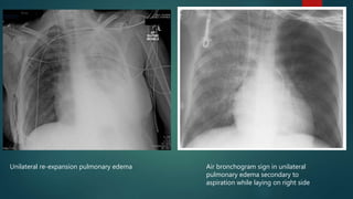 Unilateral re-expansion pulmonary edema Air bronchogram sign in unilateral
pulmonary edema secondary to
aspiration while laying on right side
 