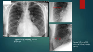 Upper lobe pulmonary venous
diversion Kerley B lines which
represent interlobular
septa
 