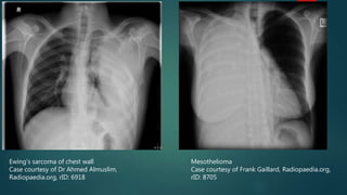Ewing’s sarcoma of chest wall
Case courtesy of Dr Ahmed Almuslim,
Radiopaedia.org, rID: 6918
Mesothelioma
Case courtesy of Frank Gaillard, Radiopaedia.org,
rID: 8705
 