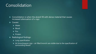 Consolidation
 Consolidation is when the alveoli fill with dense material that causes
increased attenuation of x-rays
 Causes:
 Water
 Blood
 Pus
 Protein
 Radiological findings:
 Lung opacification
 Air bronchogram sign – air filled bronchi are visible due to the opacification of
surrounding alveoli
 