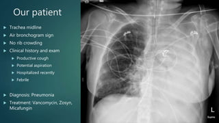 Our patient
 Trachea midline
 Air bronchogram sign
 No rib crowding
 Clinical history and exam
 Productive cough
 Potential aspiration
 Hospitalized recently
 Febrile
 Diagnosis: Pneumonia
 Treatment: Vancomycin, Zosyn,
Micafungin
 