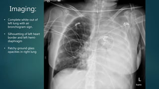 Imaging:
• Complete white-out of
left lung with air
bronchogram sign.
• Silhouetting of left heart
border and left hemi-
diaphragm
• Patchy ground glass
opacities in right lung
 