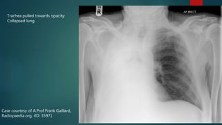 Case courtesy of A.Prof Frank Gaillard,
Radiopaedia.org, rID: 35971
Trachea pulled towards opacity:
Collapsed lung
 