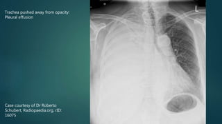 Case courtesy of Dr Roberto
Schubert, Radiopaedia.org, rID:
16075
Trachea pushed away from opacity:
Pleural effusion
 