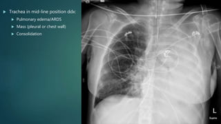  Trachea in mid-line position ddx:
 Pulmonary edema/ARDS
 Mass (pleural or chest wall)
 Consolidation
 
